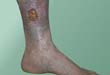 Venous leg ulcers usually appear on the inside of the lower leg.