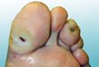 Diabetic foot ulcers often are painless.